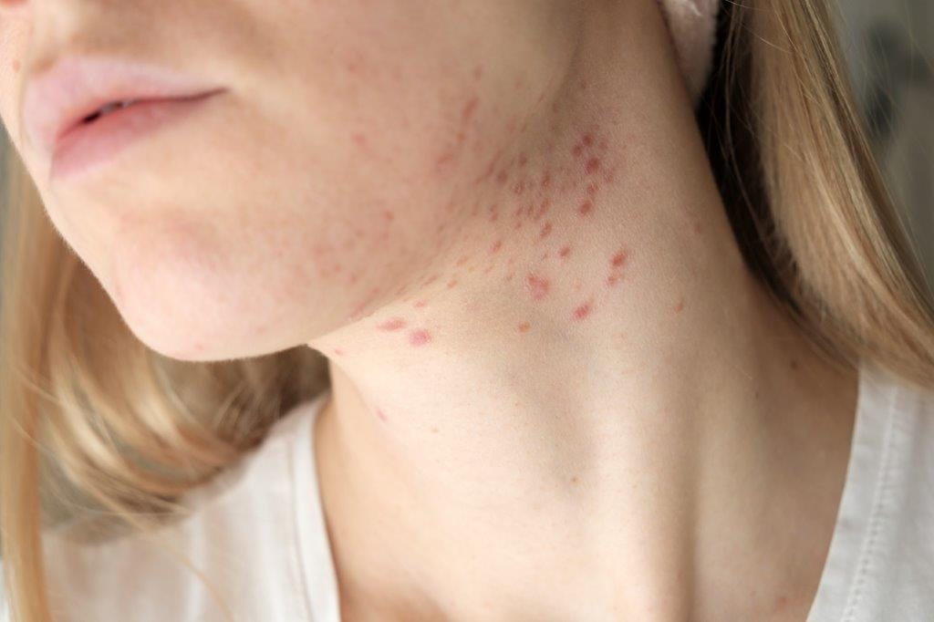 Hormonal Acne Naturopath Brisbane