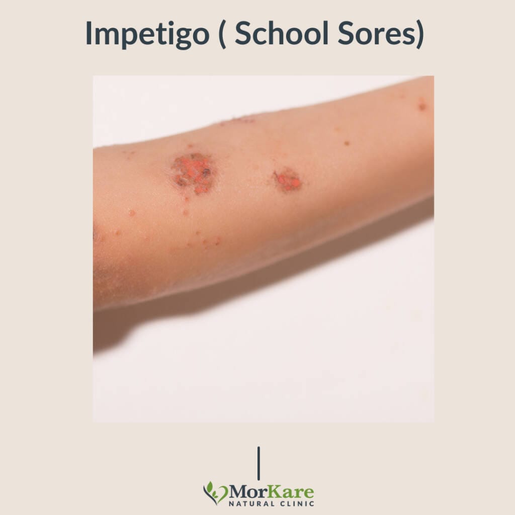 Impetigo School Sores brisbane Australia