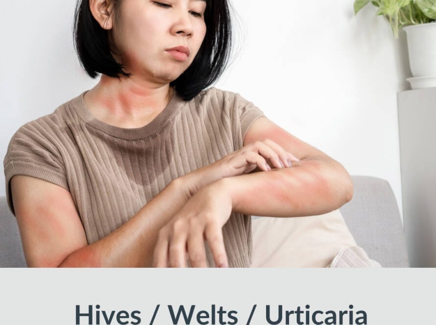 Allergy test, Hives, Urticaria, Welts Rash on the skin, eczema, Best naturopath, best Homeopath for hives,