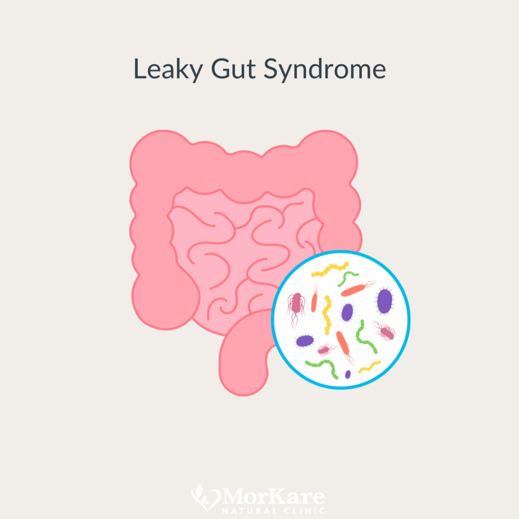 Leaky Gut Syndrome . Brisbane best Naturopath Homeopathy for Gut health