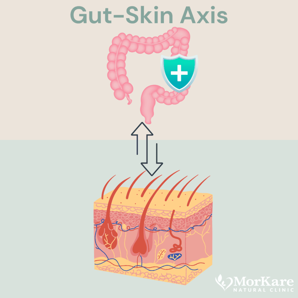 The gut-skin axis underscores the intimate connection between gut health and skin conditions. Imbalances in gut flora or digestive function can manifest as skin issues such as acne, eczema, or psoriasis. By optimizing gut health through dietary adjustments, probiotics, and naturopathic therapies, we aim to alleviate skin symptoms and promote long-term skin health.