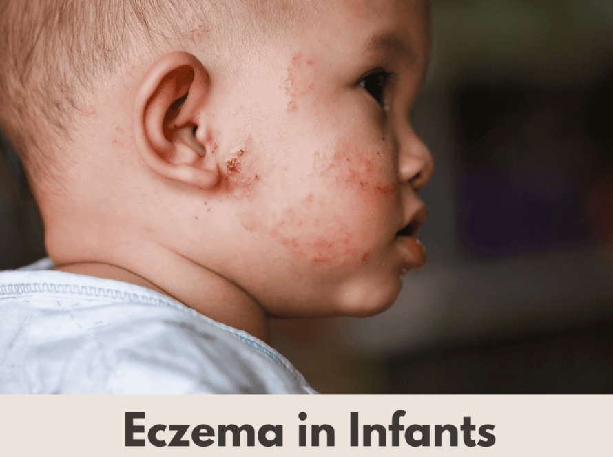 naturopath eczema, naturopathic treatment for eczema, eczema naturopath, Brisbane naturopath, eczema infants, infant eczema, eczema treatment, natural eczema treatment, holistic eczema care, Morkare Natural Clinic