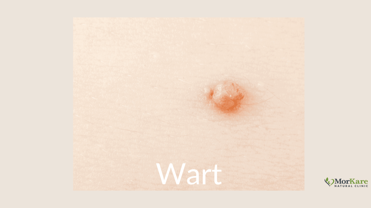 Wart off, Best Brisbane Naturopaths are providing natural treatment for you and your child to help with painful plantar warts. Topical and Oral options